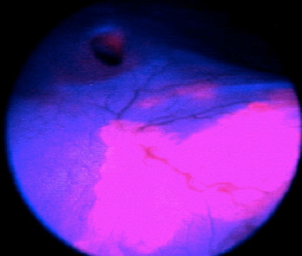 Фотодинамическая диагностика-флюоресцентная цистоскопия